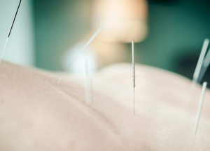 IMS and Dry Needling at Dockside Physiotherapy, Victoria, BC